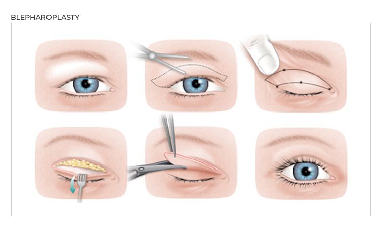 WHAT IS EYELID LIFT?